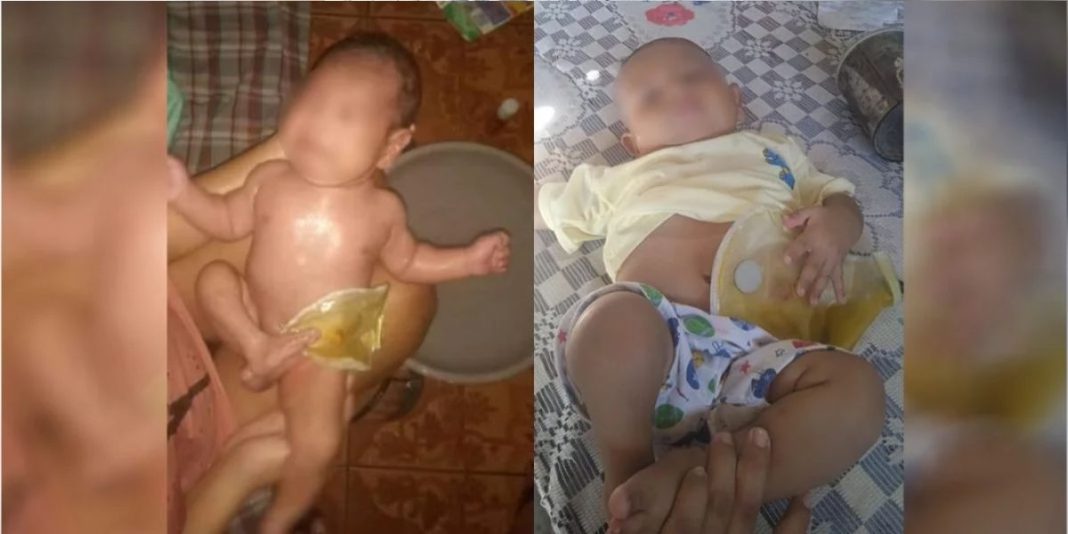 Niño que nació con ano imperforado requiere ayuda para continuar tratamiento
