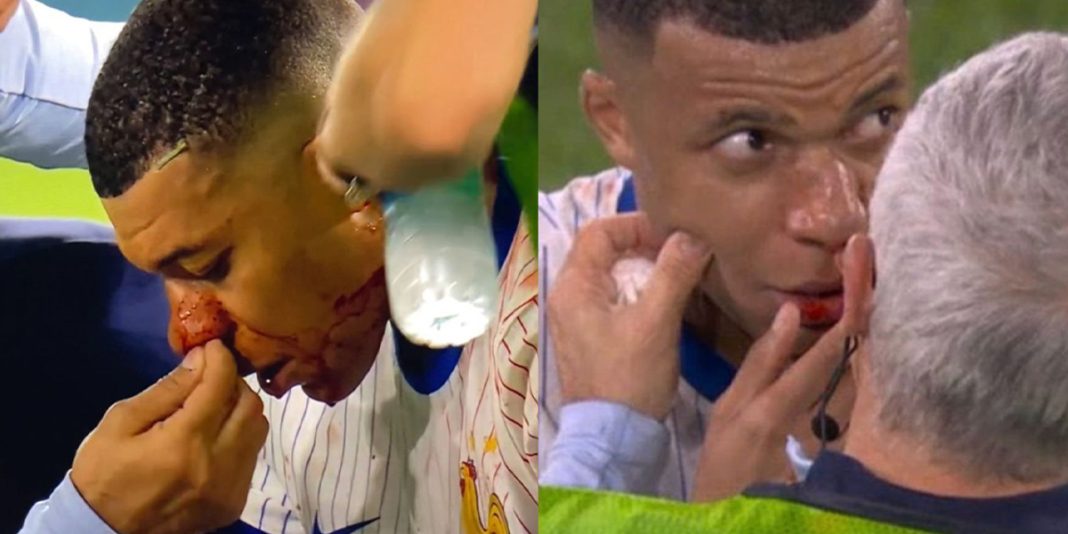 Kylian Mbappé sufre fractura nasal en partido contra Austria
