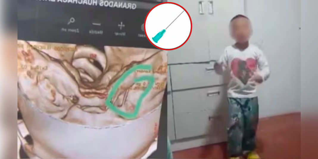 Lima: niño termina con aguja en el cerebro tras visita al dentista en hospital de EsSalud