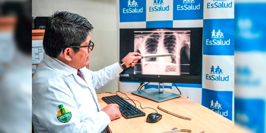 EsSalud realiza exitosa cirugía para corregir «pecho hundido» en adolescente