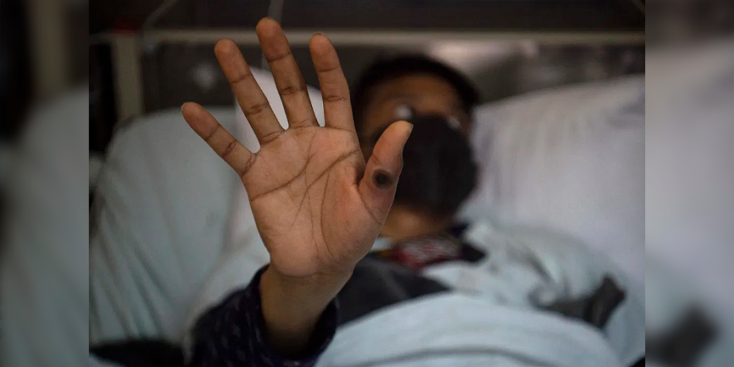 Alerta en Perú: CDC advierte sobre riesgo de variante severa de Mpox